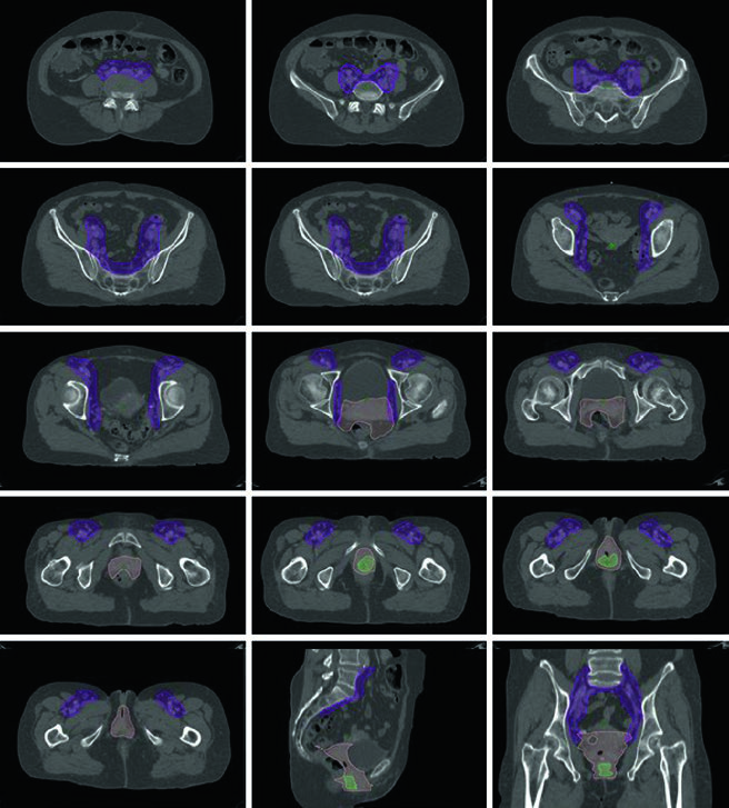 CT simulation slices for stage IVA (T4N0M0) vaginal squamous cell carcinoma with rectal involvement showing CTV1 (light green), CTV2 (orange), and CTV3 (purple) — 45 Gy in 25 fractions followed by HDR boost 21.5 Gy in 3 fractions