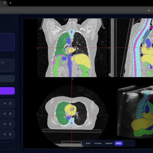VoxTell and Varian Eclipse ESAPI: AI in Radiotherapy Research