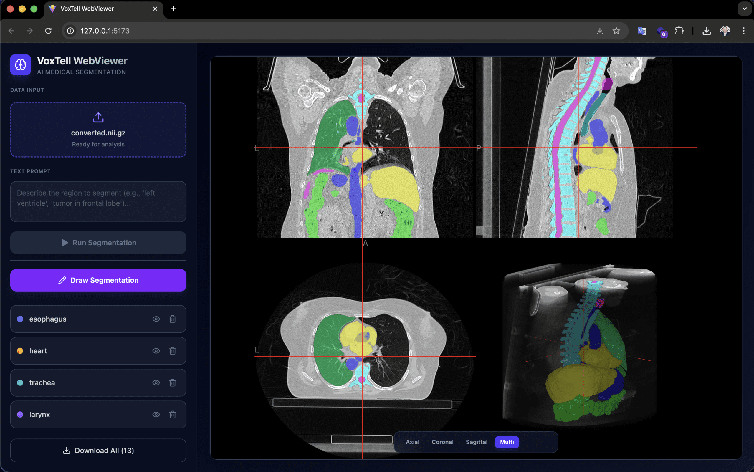 VoxTell y Varian Eclipse ESAPI: IA en Radioterapia