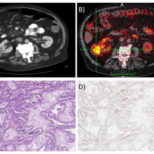 PET con Girentuximab: VPP de 98% en Tumores Renales