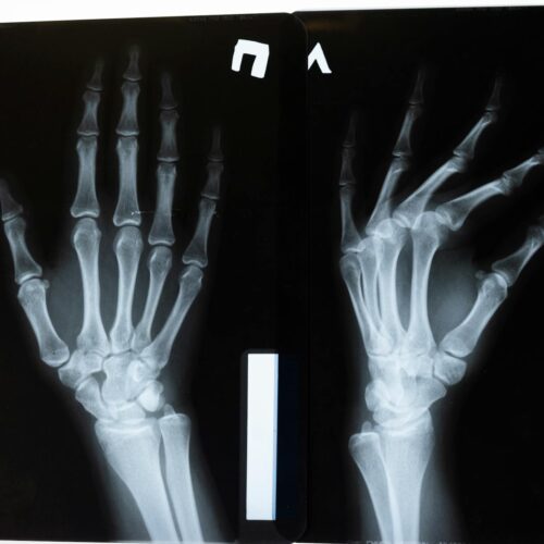 Radiomics Model Grades Hand Osteoarthritis on X-Rays