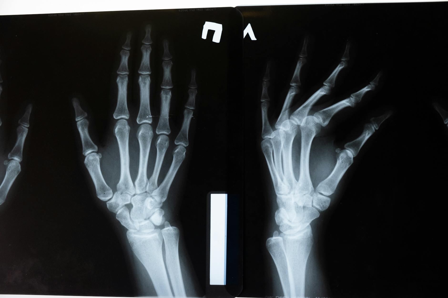 Hand radiograph showing osteoarthritis findings at the interphalangeal joints