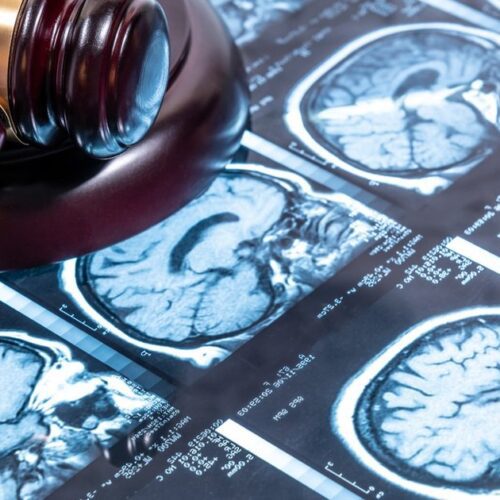 Couple Sues Radiologist Over Allegedly Missed Stroke