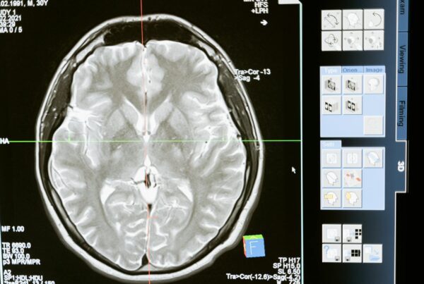 Imagens de ressonância magnética do encéfalo em estudo de pulsatilidade cerebral