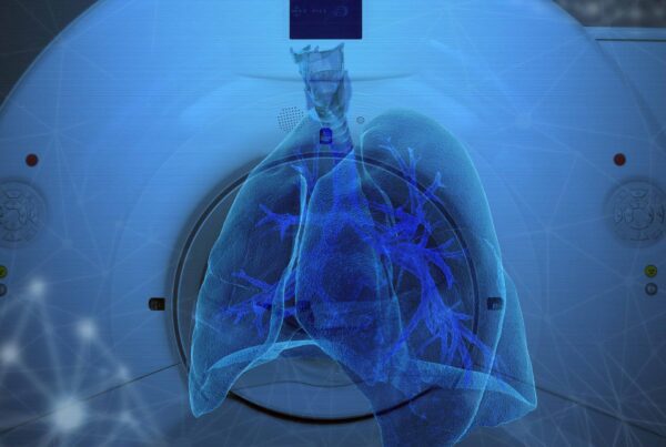 Algoritmo de IA analisa angiotomografia pulmonar para detecção de embolia pulmonar