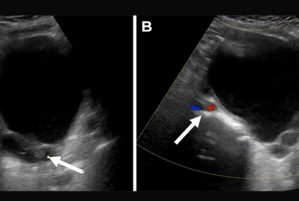Ultrassom pélvico mostrando lesão ovariana com componente sólido em mulher pós-menopáusica