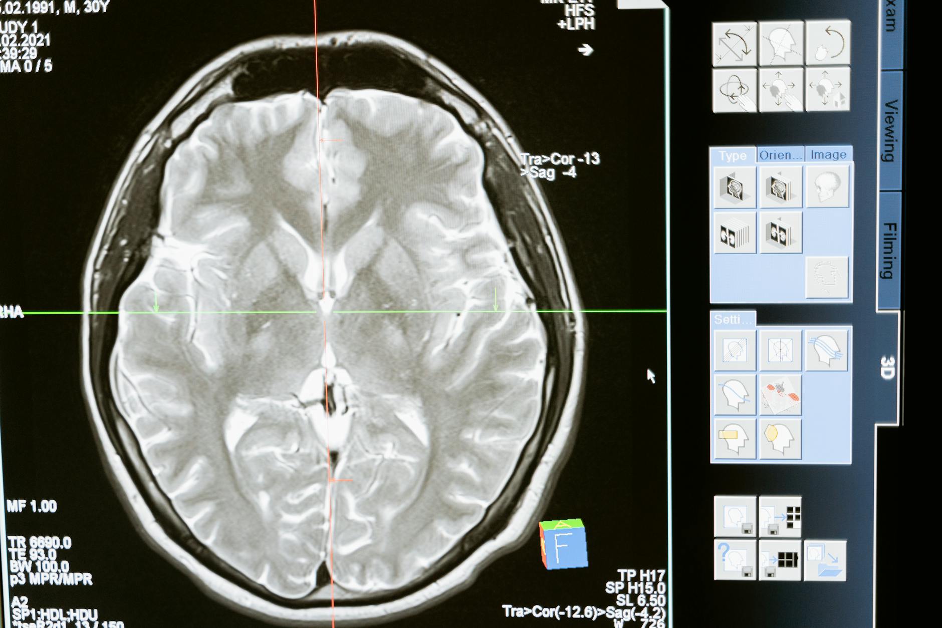 Brain MRI showing glymphatic fluid flow mapped by AI