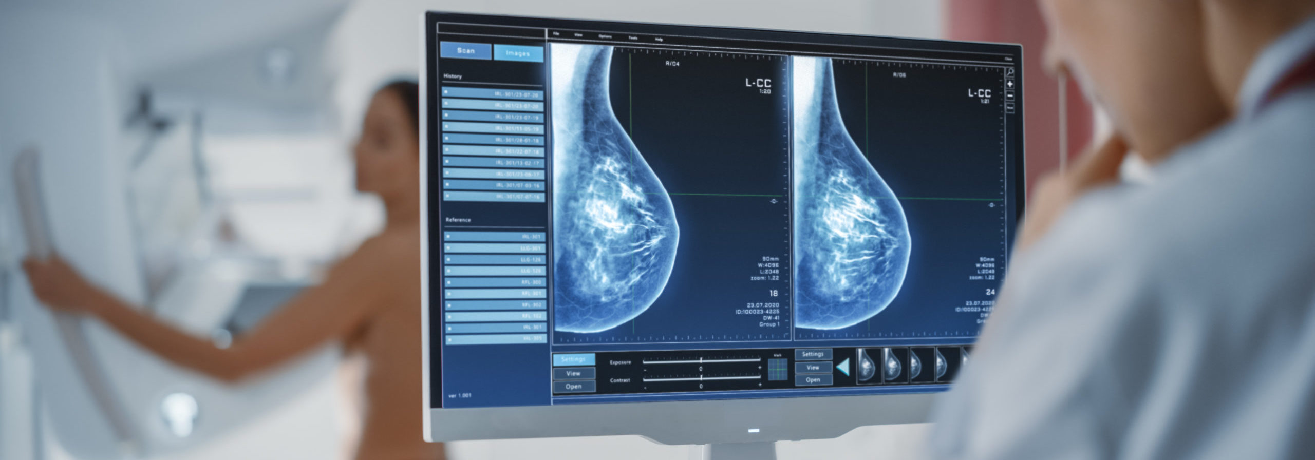 Mamografia de rastreamento analisada por inteligência artificial