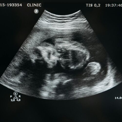 AIUM: AI Ultrasound Gauges Fetal Lung Maturity