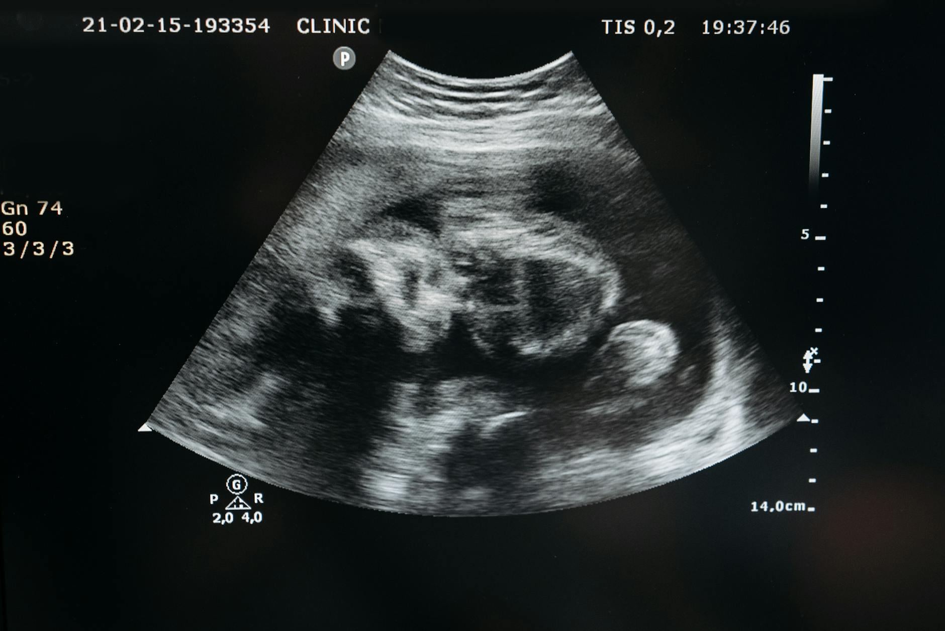 AIUM: IA no Ultrassom Estima Maturidade Pulmonar Fetal