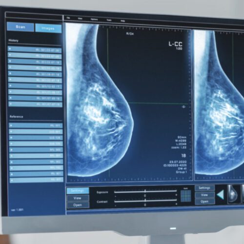 AI Could Cut 77% of Mammograms From Double Reading