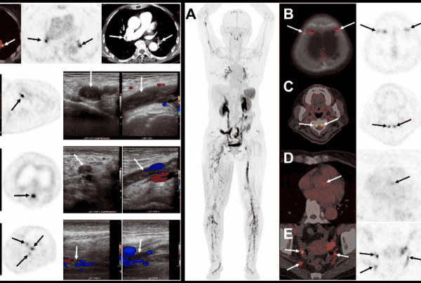 Imagem do Ano da SNMMI 2026: PET/CT com 18F-GP1 detectando trombose venosa profunda