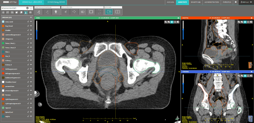 TheraPanacea ART-Plan (Annotate) interface