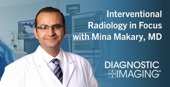 Radioembolização com ítrio-90 (Y90) para câncer de fígado em radiologia intervencionista