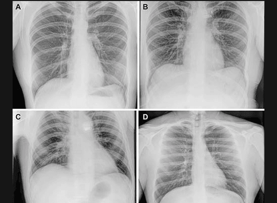Radiografia diagnóstica capturada em órbita durante a missão Fram2, exibida em computador de bordo