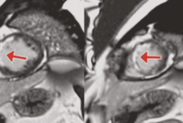 Imagens de ressonância magnética cardíaca em eixo curto mostrando cicatriz miocárdica indicada por setas, geradas sem contraste por IA (Virtual Native Enhancement)