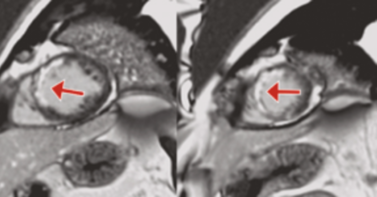 Ressonancia magnetica cardiaca em eixo curto mostrando cicatriz miocardica indicada por setas, gerada sem contraste pela IA Virtual Native Enhancement