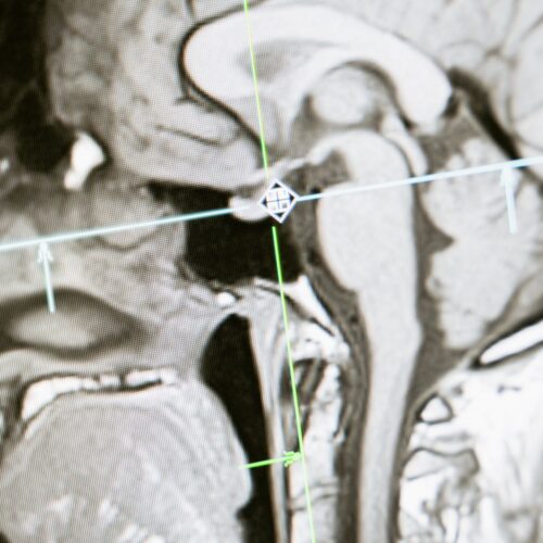 Brain Motion MRI Predicts Chiari Surgery Outcomes
