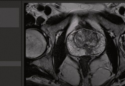 Pre-Biopsy MRI Used in Just a Third of U.S. Cases
