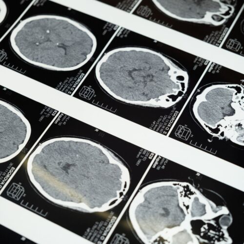 Rapid MRI Should Replace CT in Pediatric TBI