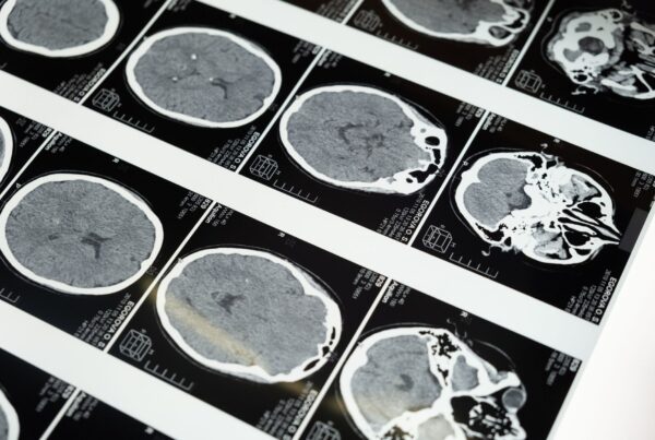 Cortes axiais de tomografia computadorizada de crânio em filme radiográfico, usados no seguimento de traumatismo cranioencefálico