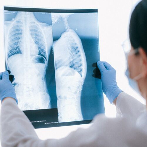 8 mm Nodule Missed, Then Stage 4 Lung Cancer
