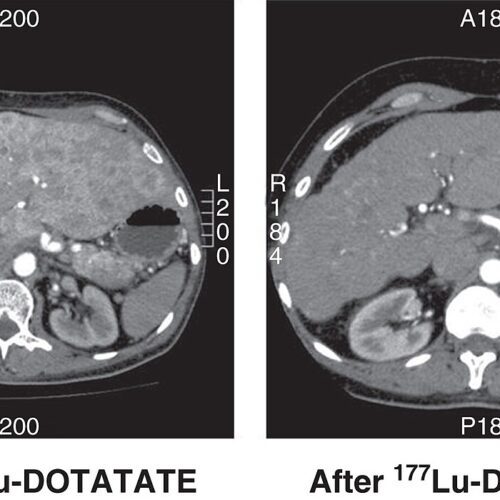 FDA Approves Bravnetsa, a Generic Lu-177 Dotatate
