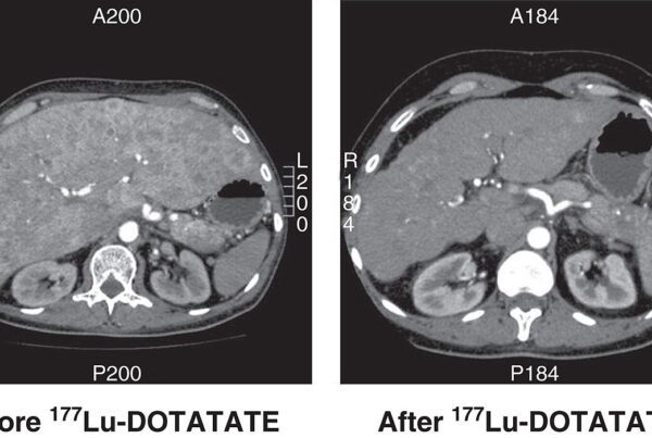 Tomografia de abdome antes e depois do tratamento com lutécio-177 dotatato mostrando redução de metástases hepáticas de tumor neuroendócrino