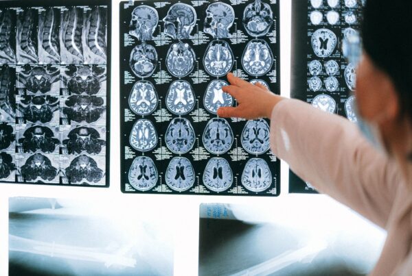Radiologista aponta para cortes de ressonancia magnetica do cerebro em negatoscopio