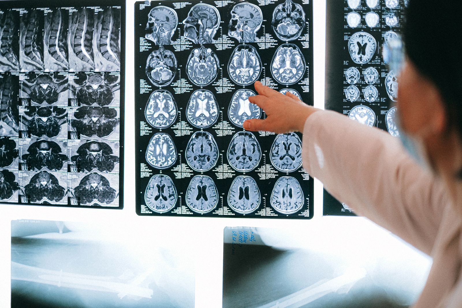 Neighborhood Deprivation Speeds Brain Aging, MRI Shows