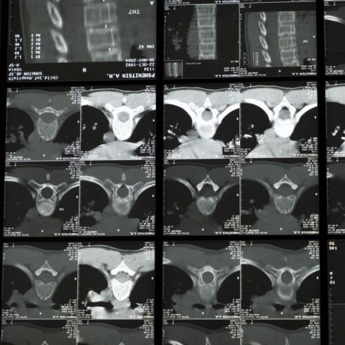 Low-Dose CT Finds Emphysema in 77% of Lung Screenees