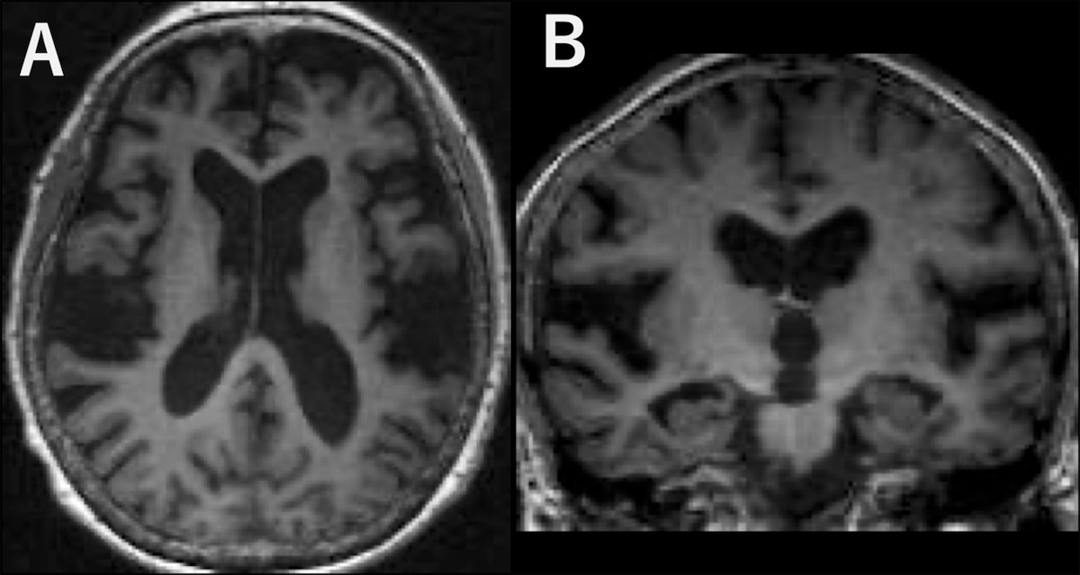 Axial and coronal T1-weighted brain MRI showing enlarged Sylvian fissures, tight high-convexity sulci and enlarged ventricles