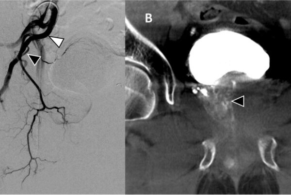 Angiografia por subtração digital mostrando artéria prostática variante originada da artéria glútea inferior e TC de feixe cônico confirmando perfusão do lobo direito da próstata durante embolização