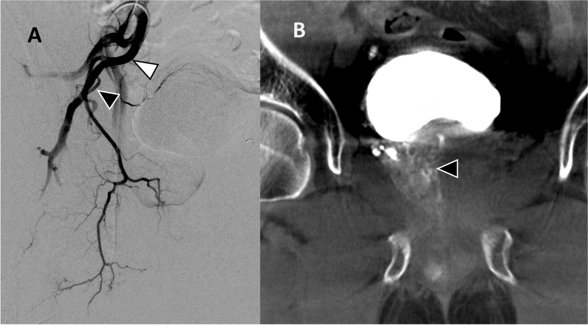 Prostatic Artery Embolization for BPH: Expert View
