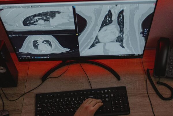 Estação de laudo de radiologia exibindo tomografia de tórax em cortes axial, coronal e sagital