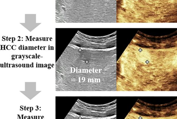 Medição do diâmetro de carcinoma hepatocelular em ultrassom em escala de cinza (19 mm) e com contraste (23 mm), mostrando perfusão além da margem