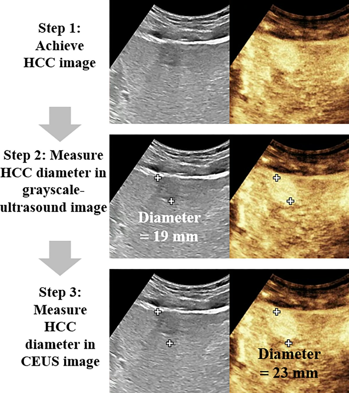 CEUS Perfusion Sign Flags Aggressive Liver Cancer