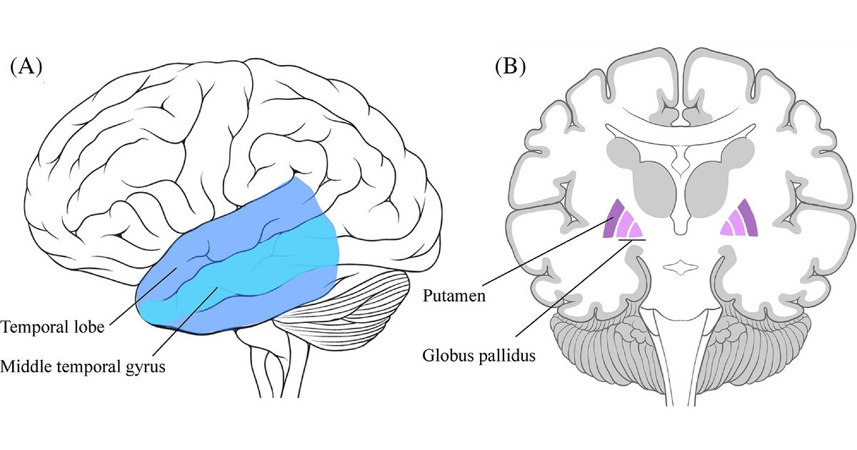 Brain anatomy illustration highlighting the temporal lobe and middle temporal gyrus (social isolation) and the putamen and globus pallidus (loneliness)